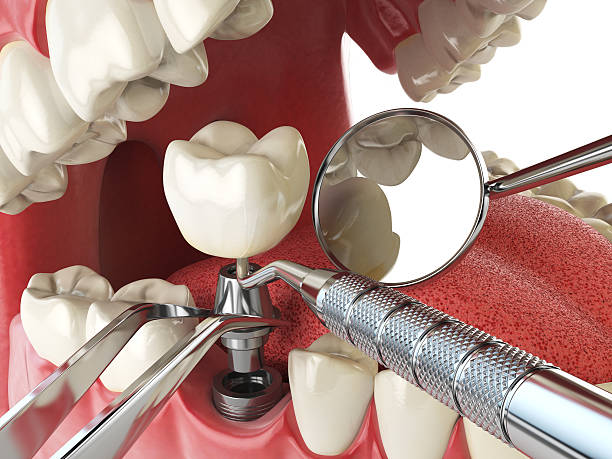 Best Emergency Dentist for Knocked-Out Tooth in Lexington, WA