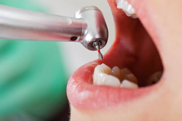 Best Emergency Root Canal Treatment in Lexington, WA